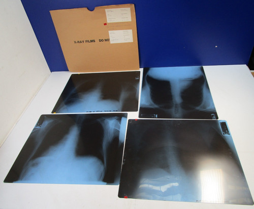 Vintage medical ray - vintage, chest