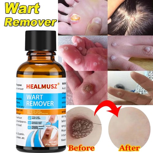 Wart remover liquid fast - wart, liquid,fast