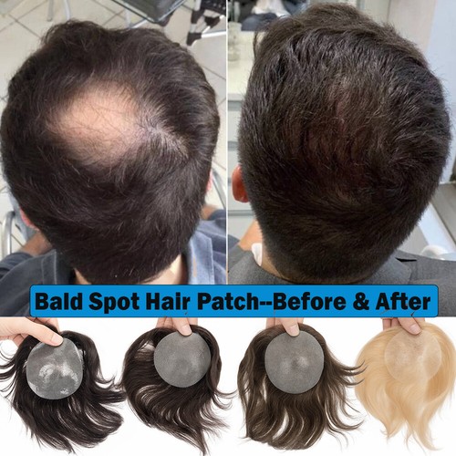 8cm bald spot hair patches - bald,