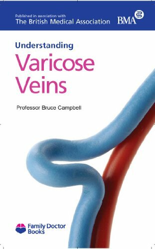 Varicose veins - varicose,