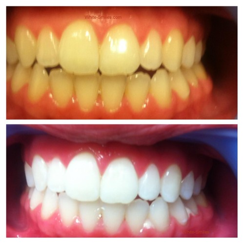 Strong teeth whitening - strong,