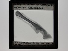 Early X-Ray / Rontgen Ray Of