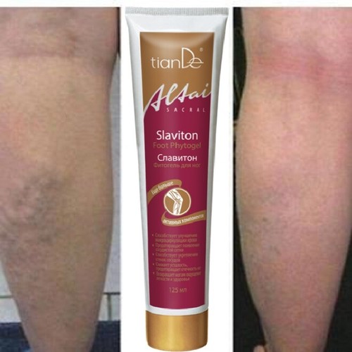 Varicose veins legs - veins, sore