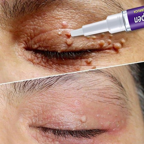 Pack skin tag remover pen - 1,