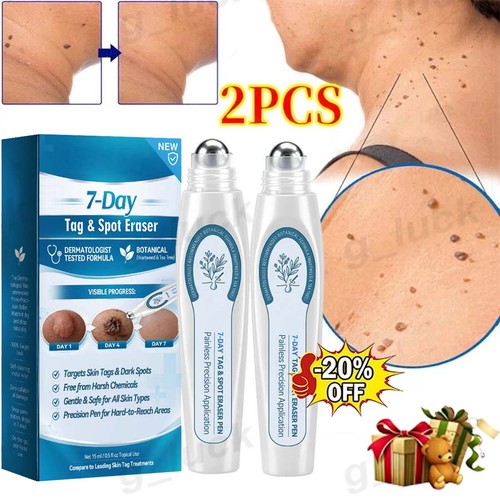 Painless mole skin removal - skin,