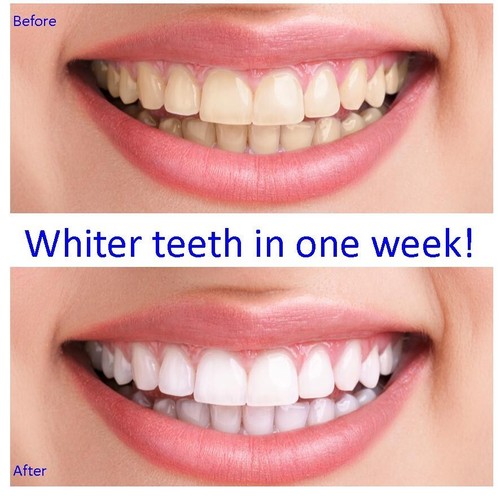 Very strong teeth whitening - ,