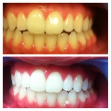 Very Strong Teeth Whitening
