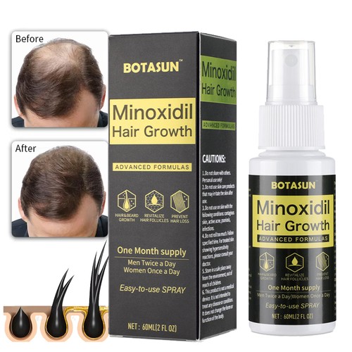 Minoxidil hair regrowth - minoxidil,
