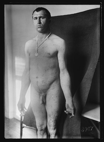 Photo 1918 skin diseases - skin, nude