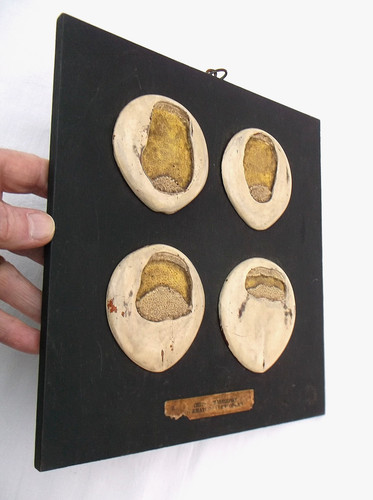 Rare antique anatomical - rare,