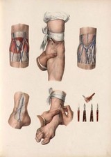 Antique medical blood letting