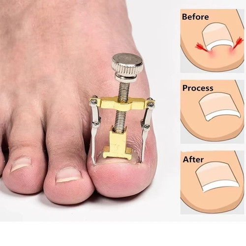 Ingrown toenail treatment toe - ingrown,