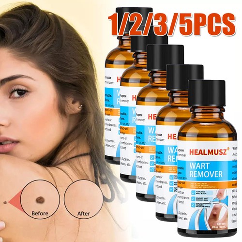 Wart remover fast acting and - fast,