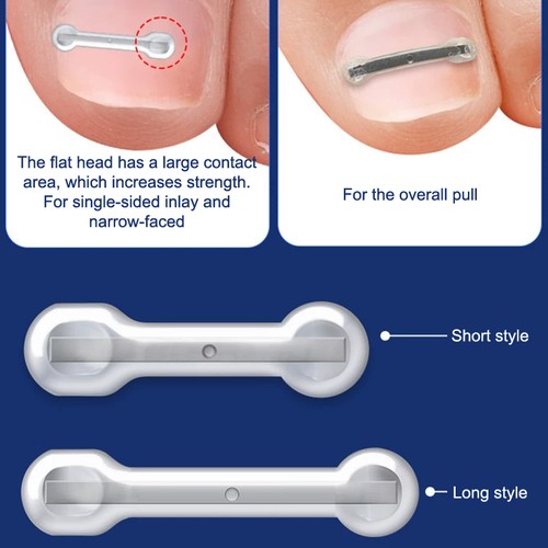 10pcs ingrown toenail - 10pcs,