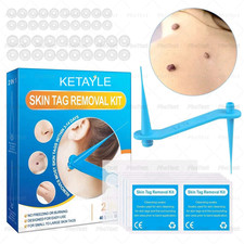 Rubber Bands Skin Tag Remover