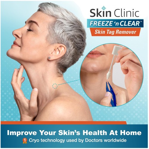 Skin tag remover kit - skin,