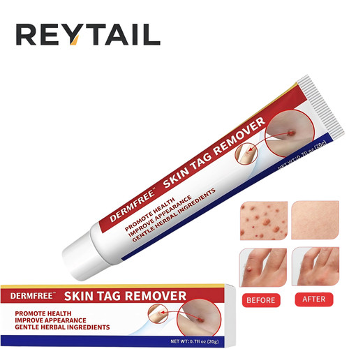 Strong skin tag remover cream - strong,
