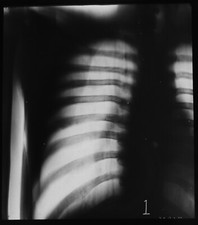 XRAY OF A HUMAN CHEST NO10 C1950 Magic Lantern Slide VINTAGE MEDICAL PHOTO