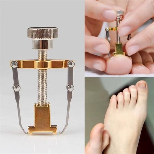 Straightening clip ingrown - clip,