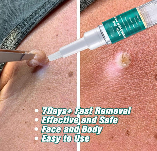 Days wart remover pen - 7, skin