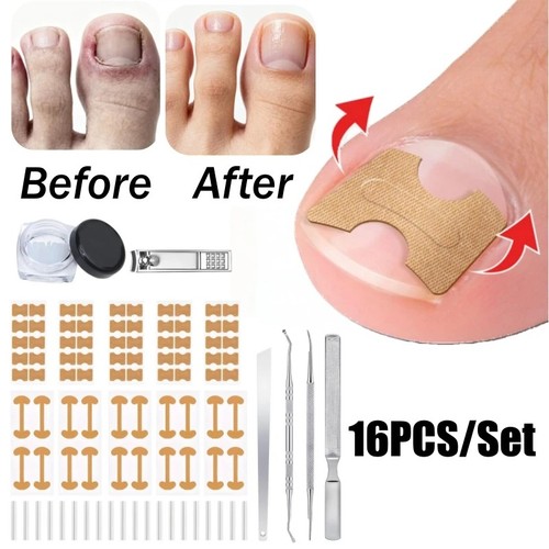 Ingrown toenail treatment - toenail,
