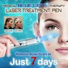Blue Light Beauty Pen Varicose Veins Therapy Acne Laser Pen Scar Removal Beauty 