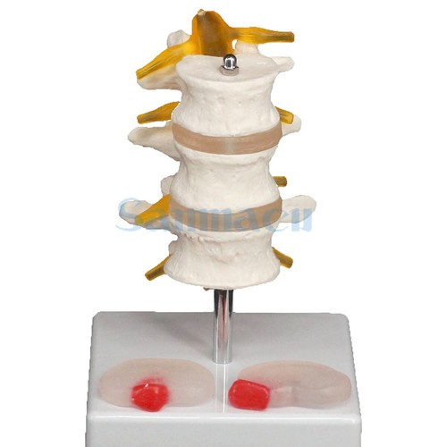 Human three lumbar lesions - three,