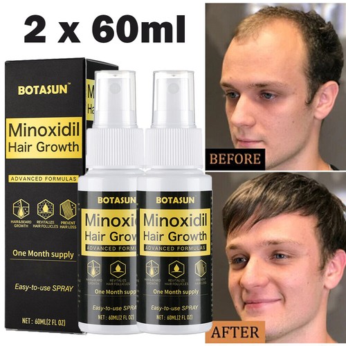 Pack minoxidil hair - minoxidil,