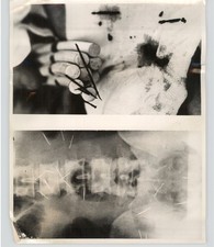 X-RAY Sewing Needles Swallowed Removed with Magnet TOKYO 1963 Press Photo