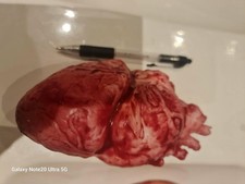 Heart  prop prosthetic  for