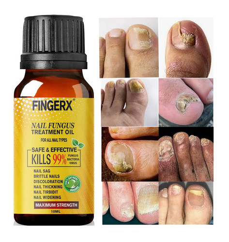 Best fungal nail treatment - best,