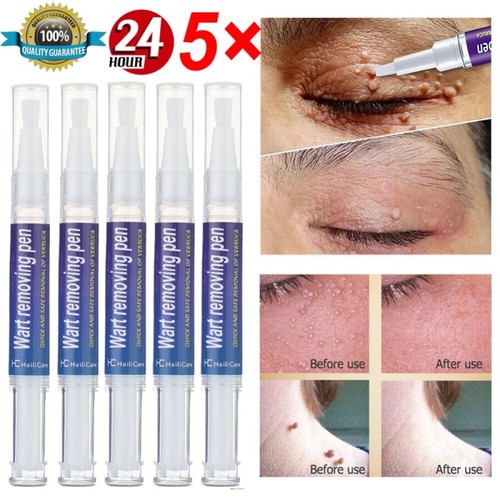 1pc wart remover liquid - 5/1pc,