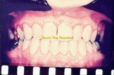 DENTAL RETAINER WIRE FIXED APPLIANCE ORTHODONTIC VIEW 35MM SLIDE