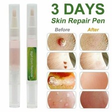 Skin Tag Removal Treatment