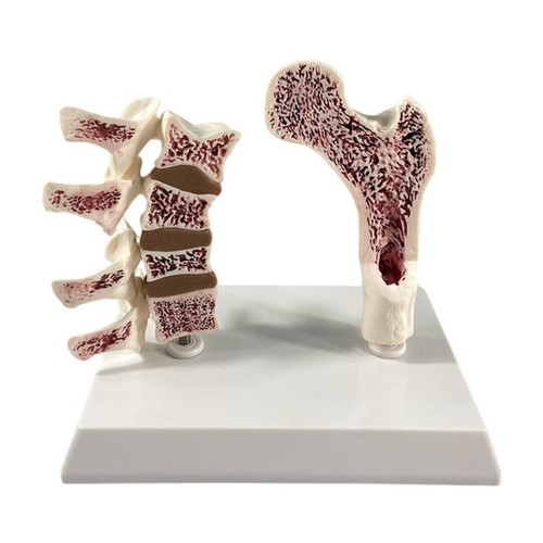 Human femur osteoporosis - femur,