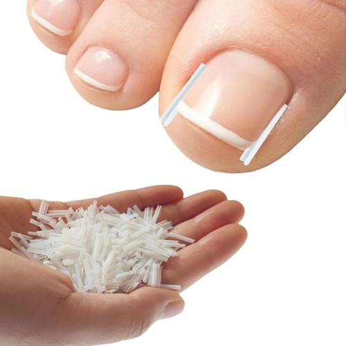 Ingrown toenail correction - ingrown,