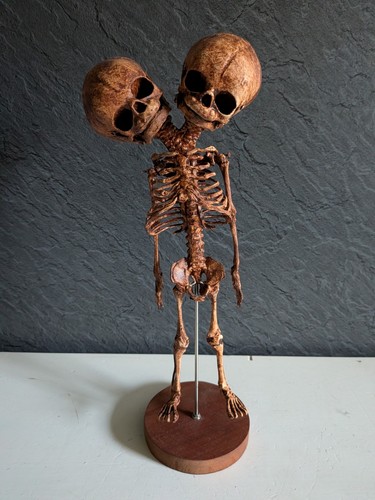 Conjoined twins skeleton - conjoined,