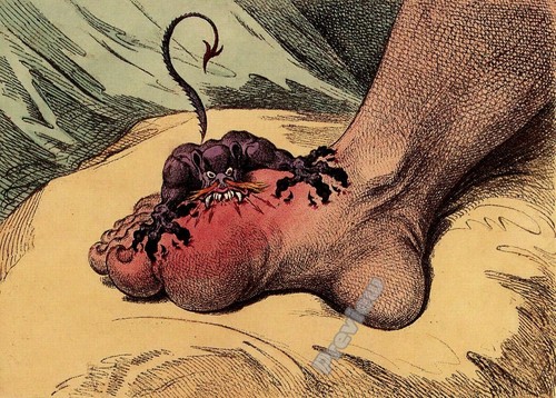 The gout james - gout, 1799