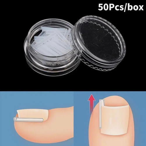 50pcs box ingrown toe - ingrown, nail