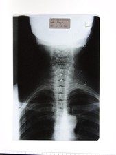 VTG 1972 Medical X-Ray Spine Neck Anatomy British School Of Osteopathy Photo
