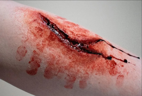 Large wound prosthetic - large,