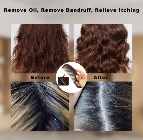 Detoxing comb scalp energy - scalp,