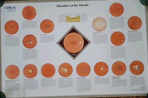 Disorders macula alcon - disorders, of