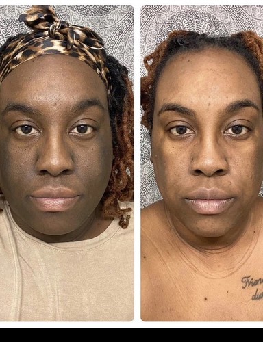 Fast skin whitening bleaching - skin,