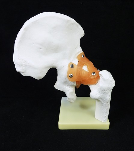 Human right hip joint - hip, doctors