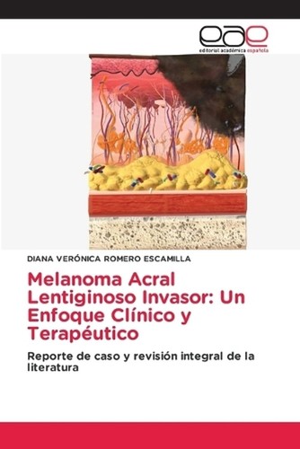 Melanoma acral lentiginoso - melanoma,