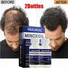 2 Months Extras Strength Unisex Regrowth Treatment Regain Hair Growth Solution