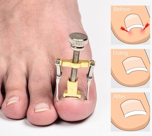 Ingrown toenail manicure - toenail,