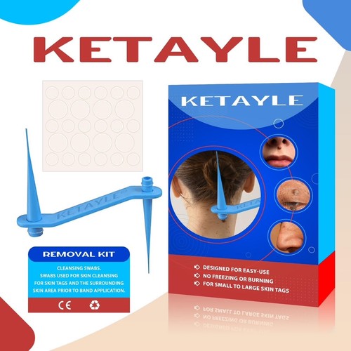 Rubber bands skin - tag, remover