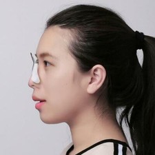 Non surgical nose job - surgical, clip